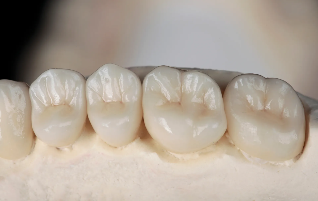 Dental Lab for Ceramic Crowns Dodge City, KS: Local Craft, Lasting Smile