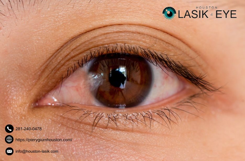 Practical Guide to Removing Pterygium Safely Practical Guide to Removing Pterygium Safely
