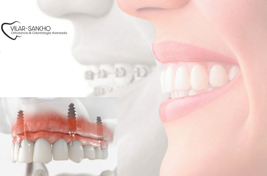 Descubre el precio de implantes en Pozuelo de forma clara Descubre el precio de implantes en Pozuelo de forma clara
