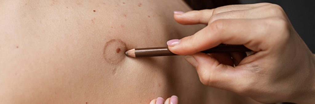 A practical guide to non surgical vitiligo treatment in Dubai