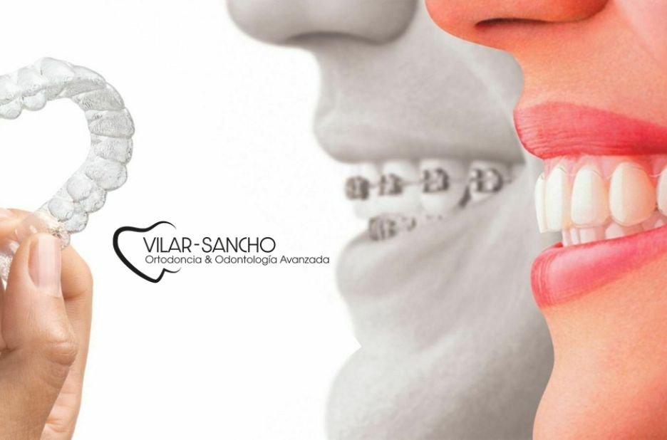 Ortodoncia en Pozuelo: guía práctica para sonreír con confianza Ortodoncia en Pozuelo: guía práctica para sonreír con confianza