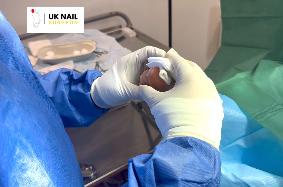 Practical care for kids with ingrown toenails Practical care for kids with ingrown toenails