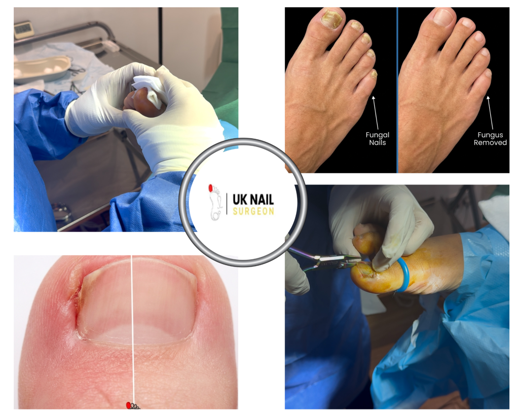 Toenail Treatment Options for Persistent Fungal Infections