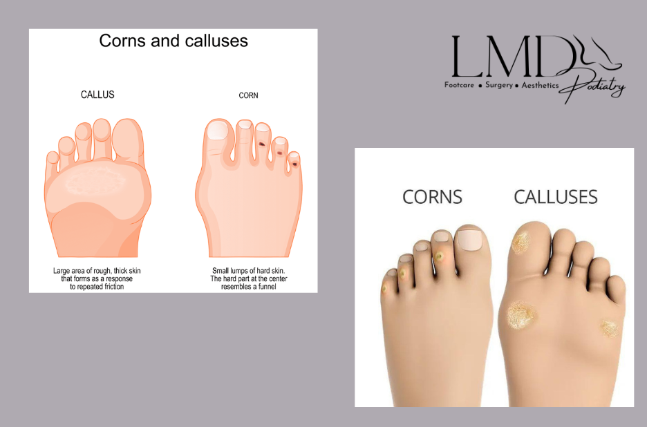 Effective Painful Callus On Foot Treatment for Lasting Relief and Healthy Feet Effective Painful Callus On Foot Treatment for Lasting Relief and Healthy Feet