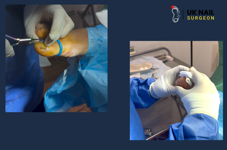 Effective Ingrown Toenails Treatment for Fast, Pain-Free Recovery at UK Nail Surgeon Effective Ingrown Toenails Treatment for Fast, Pain-Free Recovery at UK Nail Surgeon